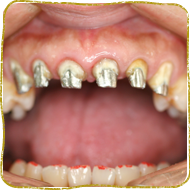 日立市・田所歯科医院・セラミック治療の症例