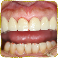 日立市・田所歯科医院・セラミック治療の症例