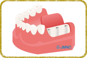 日立市・田所歯科医院・インプラント埋入手術＆固着を待つ