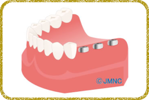 日立市・田所歯科医院・2次手術（上部構造取り付け）