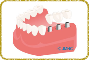 日立市・田所歯科医院・補綴処置