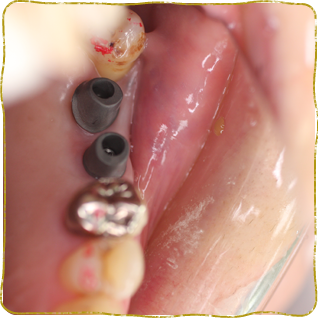 日立市・田所歯科医院・症例写真