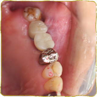 日立市・田所歯科医院・症例写真